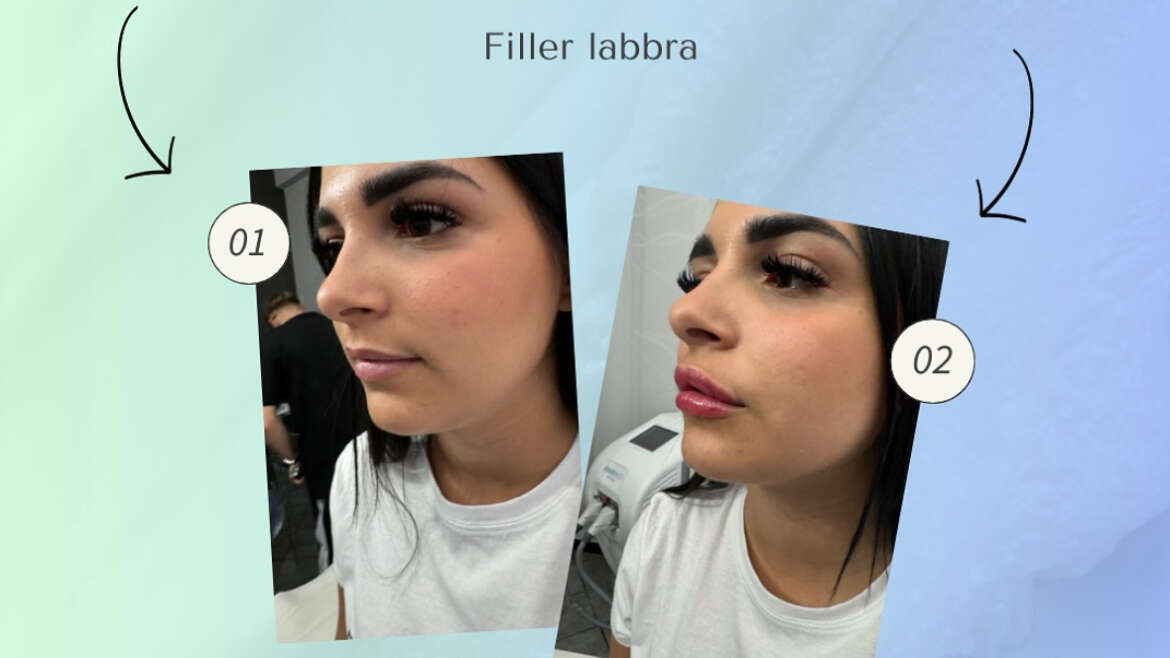 Filler labbra